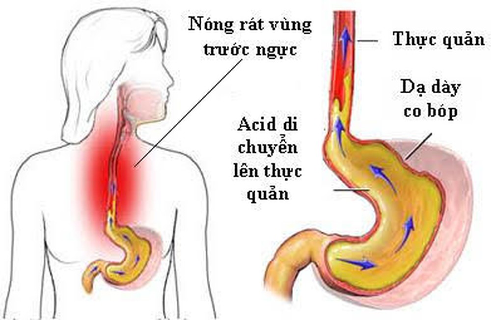Trào ngược dạ dày thực quản - Hình ảnh minh họa